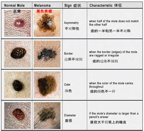 胸有大痣|你身上的痣会癌变吗？医生分析了100多颗黑痣，快来。